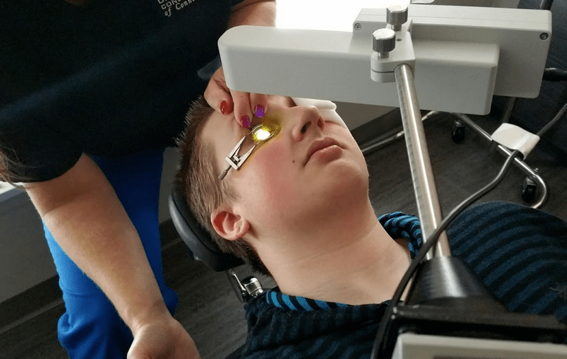 Blending effectively eliminates the beginning of the development of keratoconus