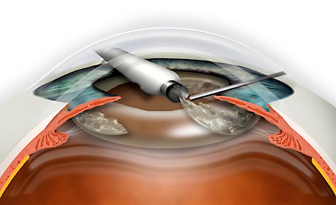 Refractive replacement of the lens is carried through a micronadi excluding blood loss