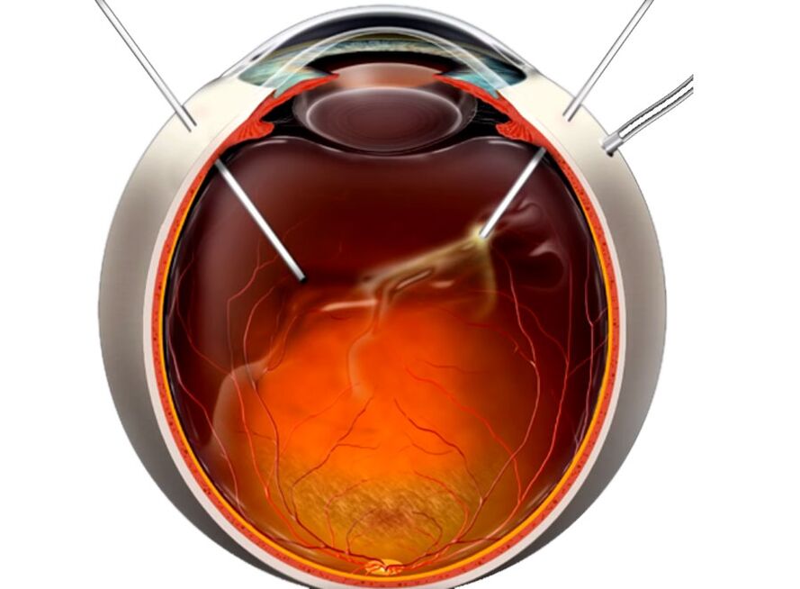 Vitrectomy - a procedure shown to people during retinal wear